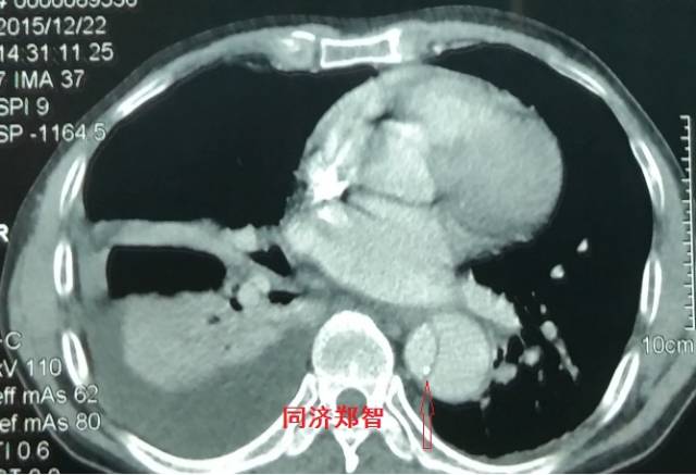 主动脉夹层cta能扫描出来吗,急性主动脉夹层cta影像诊断与鉴别