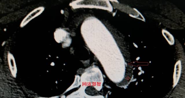 主动脉夹层cta能扫描出来吗,急性主动脉夹层cta影像诊断与鉴别