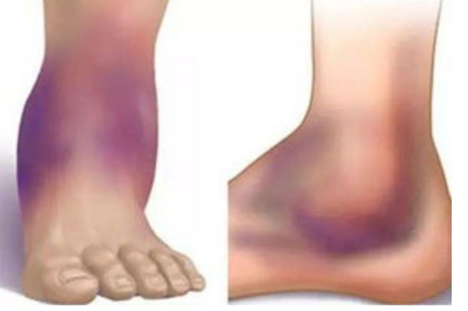 科普|脚部有五大“健康黑洞”，足踝专家为你逐一点破！