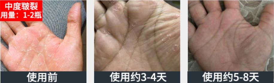 脚后跟套上这个“*钟金**罩”夏季穿鞋嫩到反光！干裂、老茧、死皮都没了！