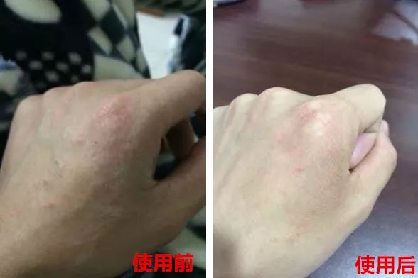 脚后跟套上这个“*钟金**罩”夏季穿鞋嫩到反光！干裂、老茧、死皮都没了！