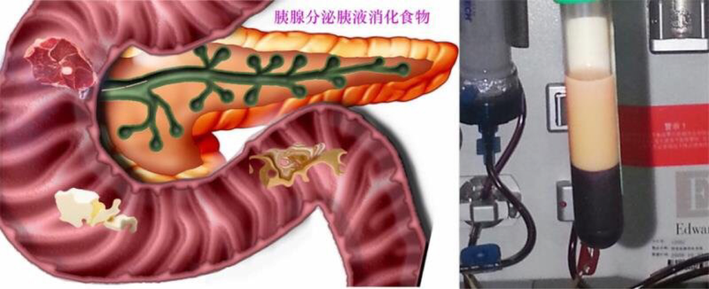 体重340斤，血脂高到仪器爆表！压塌CT机，瑞金医护团队成功救治重症急性胰腺炎患者