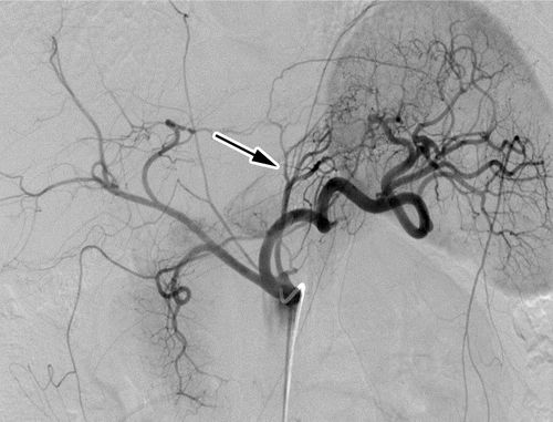 胃动脉栓塞减肥费用,栓塞胃左动脉减肥副作用
