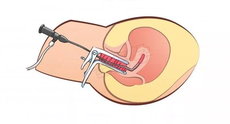 健康三亚丨你了解宫腔镜吗？