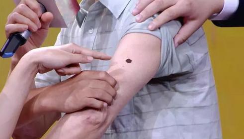 黑痣长在这几个部位需要提高警惕,凸出来的黑痣容易癌变吗