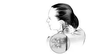 千万别乱挤痘痘一不谨慎就进了icu,挤掉痘痘后留了个洞