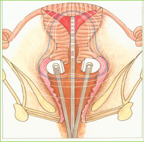 妇产科普|“隐形的手术刀”——揭秘宫颈癌的放射治疗（上）