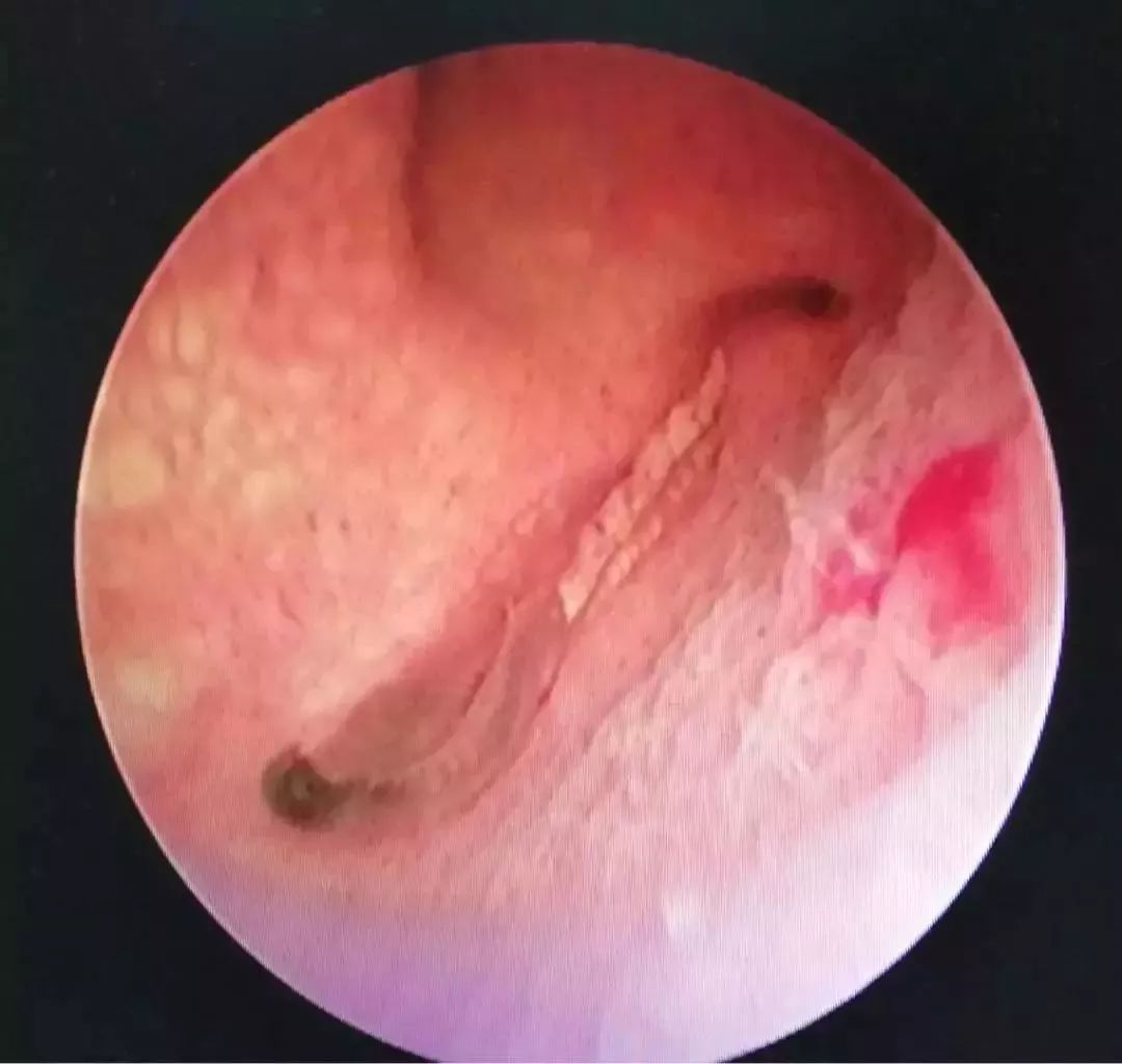 体内揪出活虫,男子体内排出活虫只因爱吃一道菜