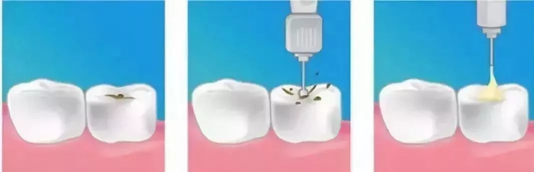 儿童换牙期牙周炎怎么治疗,蛀牙了怎么预防牙周炎