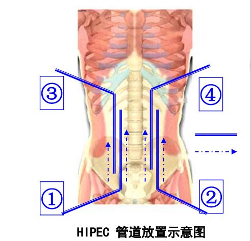 高温治疗癌细胞获国家科技进步奖,43度恒温热水灌注将癌细胞烫死