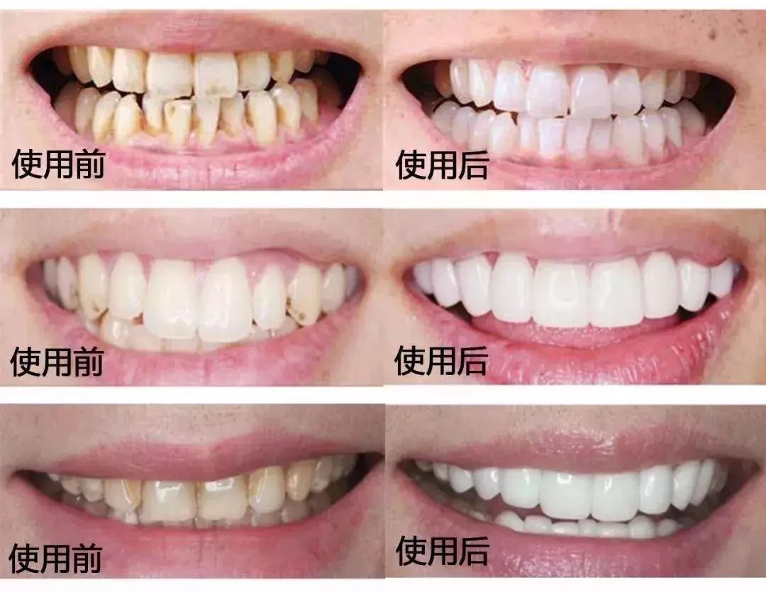牙齿不好用什么牌子牙膏最好,牙齿超级不好用什么牙膏