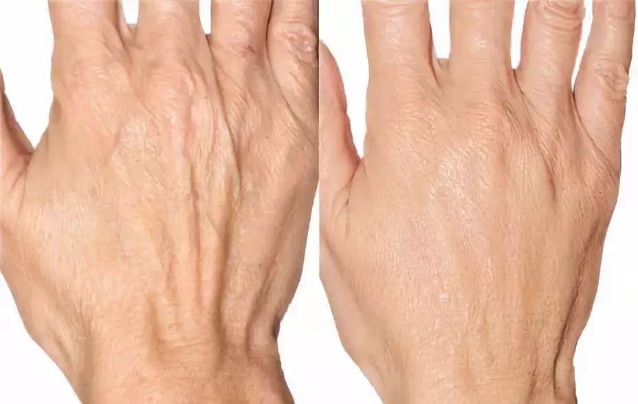 坚持7天的细纹消失,没有细纹但是有斑点