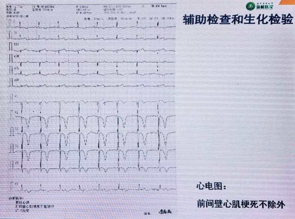CCIF2019丨黄岚教授：急性/亚急性支架血栓的处理策略