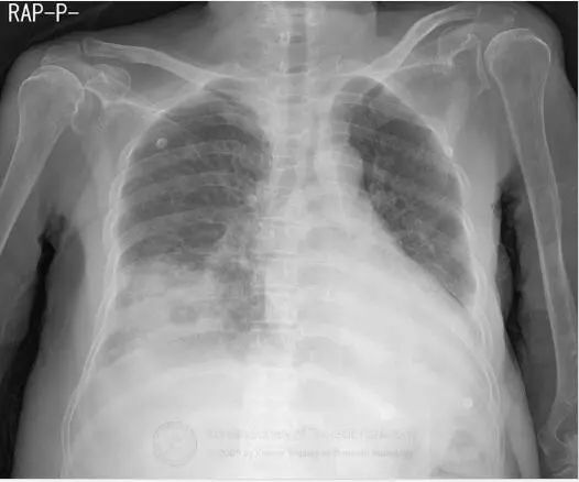 肺空洞性疾病的鉴别,肺空洞多见于哪些疾病