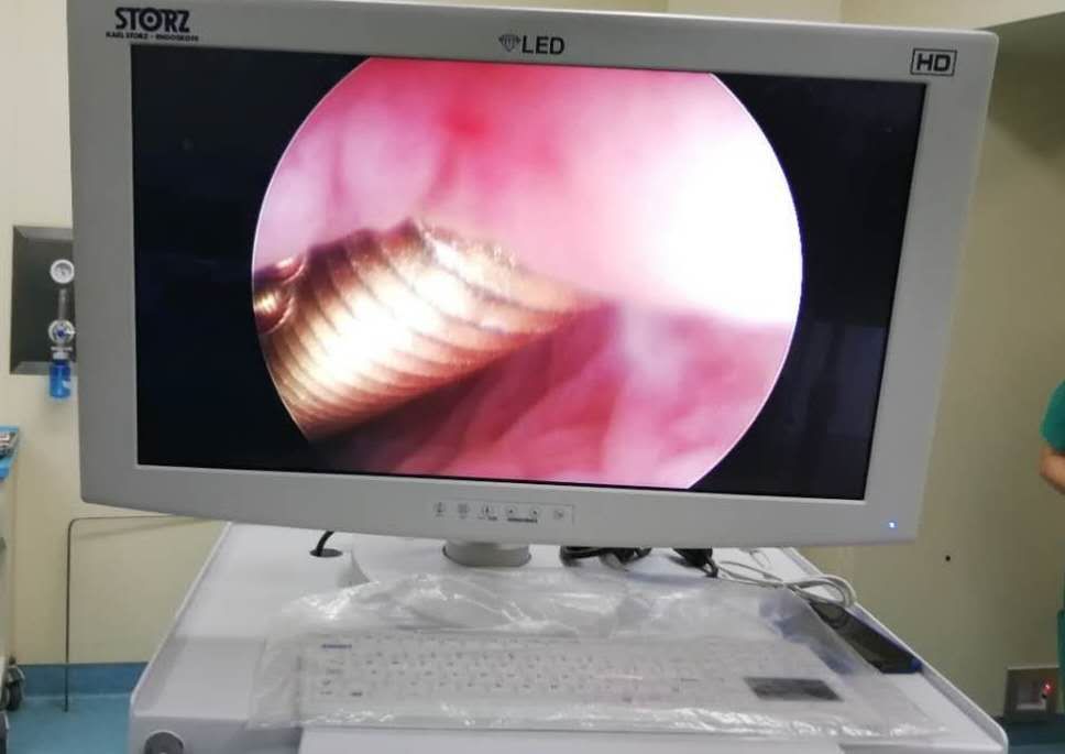 3岁儿童误吞螺丝钉,3岁女童掉落螺丝钉