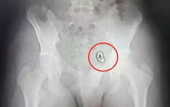 3岁儿童误吞螺丝钉,3岁女童掉落螺丝钉