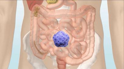湿气不走，又胖又丑！睡前一贴，逼走体内20多年的湿寒，轻松甩掉失眠、大肚腩