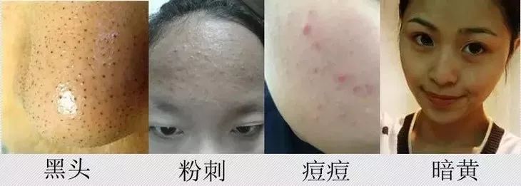 螨虫在脸上爬好不好,螨虫爬过的东西还能用吗