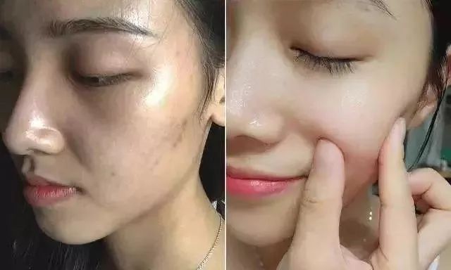 螨虫在脸上爬好不好,螨虫爬过的东西还能用吗