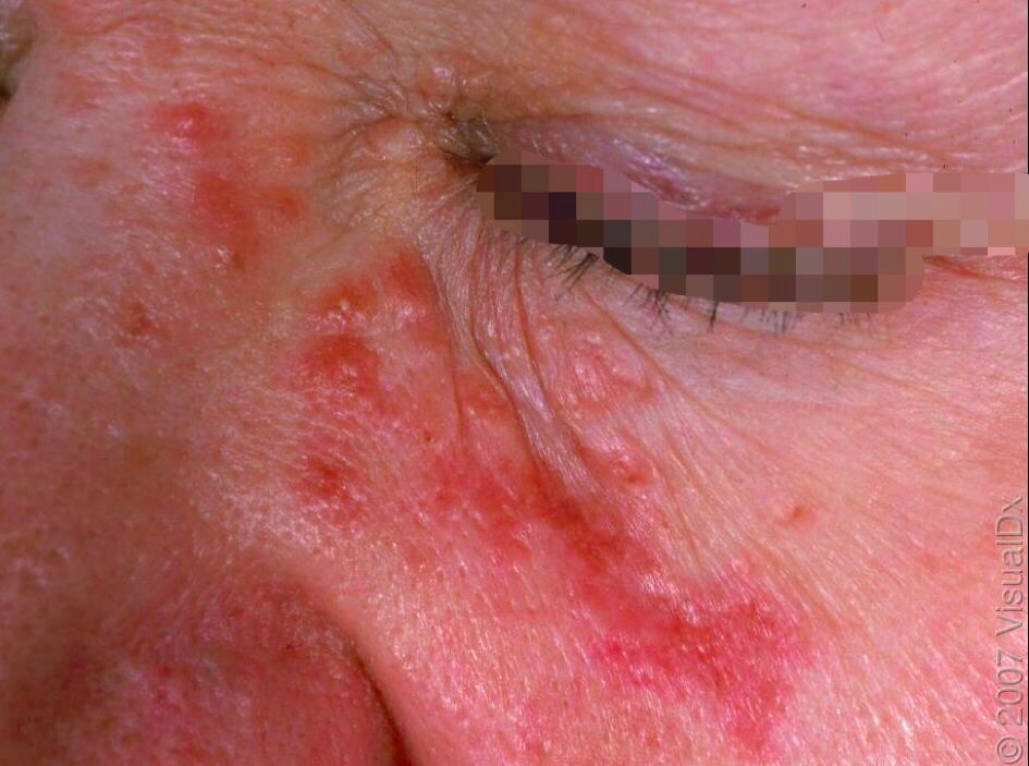 哪种皮肤病容易被误判为银屑病,容易被误诊为疥疮的皮肤病