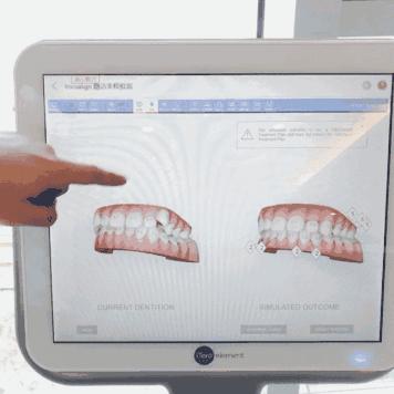 无锡缺牙优惠补贴多少钱,缺牙人士看过来种牙补贴免费领