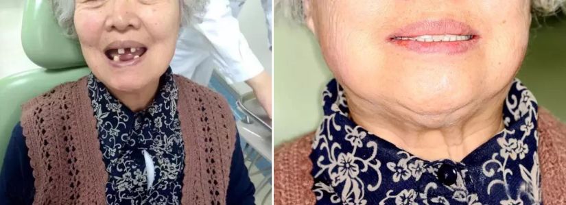 无锡缺牙优惠补贴多少钱,缺牙人士看过来种牙补贴免费领