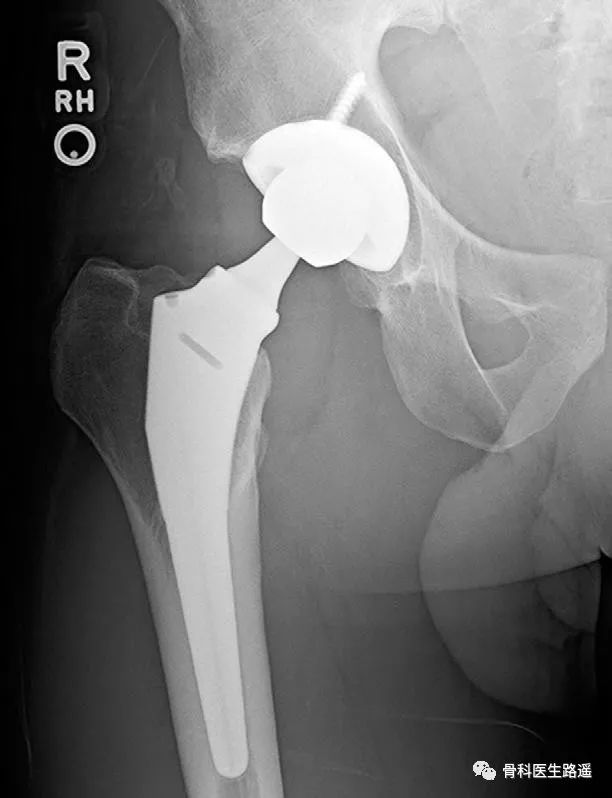 全髋置换最新技术,人工髋关节置换后可以正常跑步