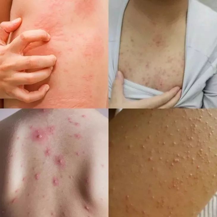 20分钟清理背部螨虫痘痘,十秒去除螨虫