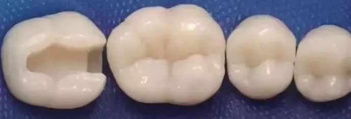 一颗蛀牙修补要多久,一颗蛀牙拔了能直接矫正吗