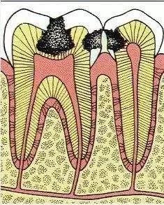 一颗蛀牙修补要多久,一颗蛀牙拔了能直接矫正吗