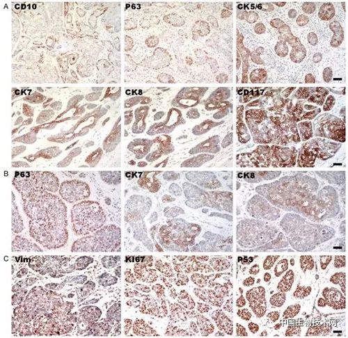 腺样囊性癌为低度恶性肿瘤,全国权威治疗腺样囊性癌的专家