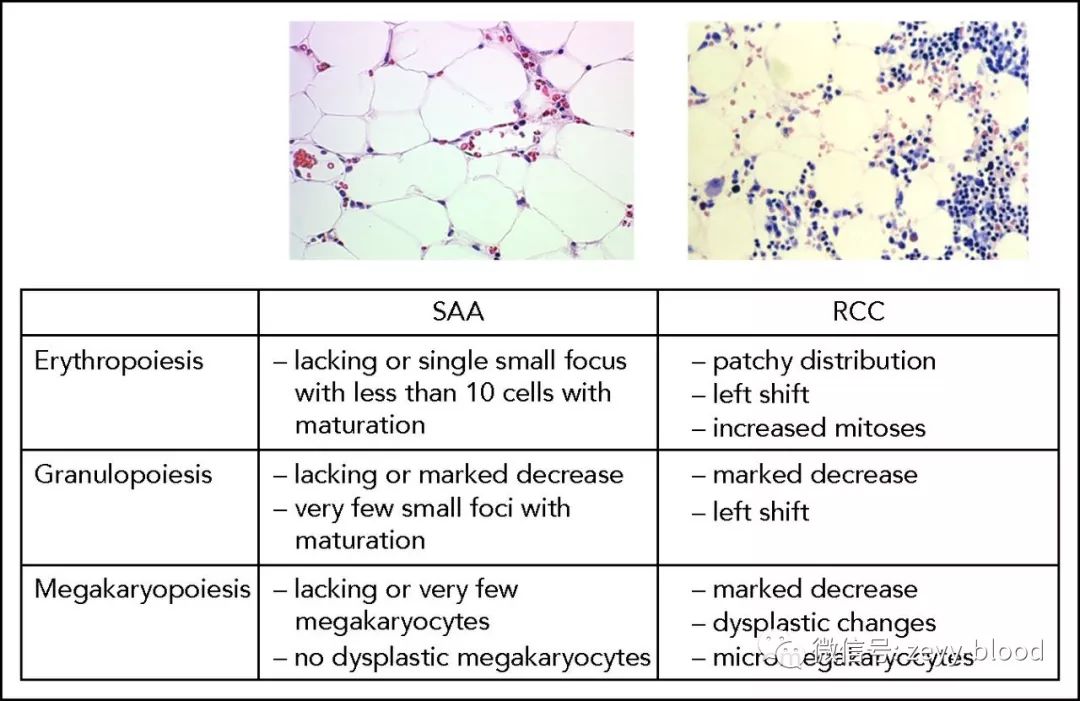 儿童mds骨髓移植生存期,儿童mds诊断专家共识
