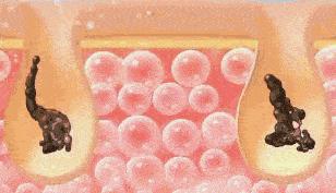 鼻头总是挤出白色丝条中医辨证,鼻头一挤就有白丝