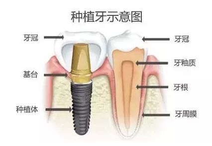 全新数字化种牙技术,3d导板种植牙新技术