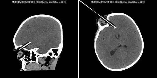 16张非常恐怖的X光照片