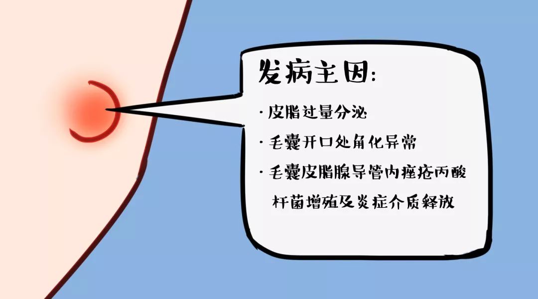 辟谣特工队|吃避孕药能战“痘”成功吗？