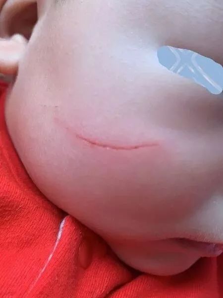 面部伤口美容缝合后关注事项,面部美容缝合视频