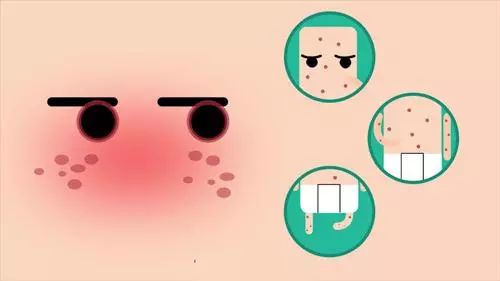 风疹为啥不让见风,风疹不治自愈吗