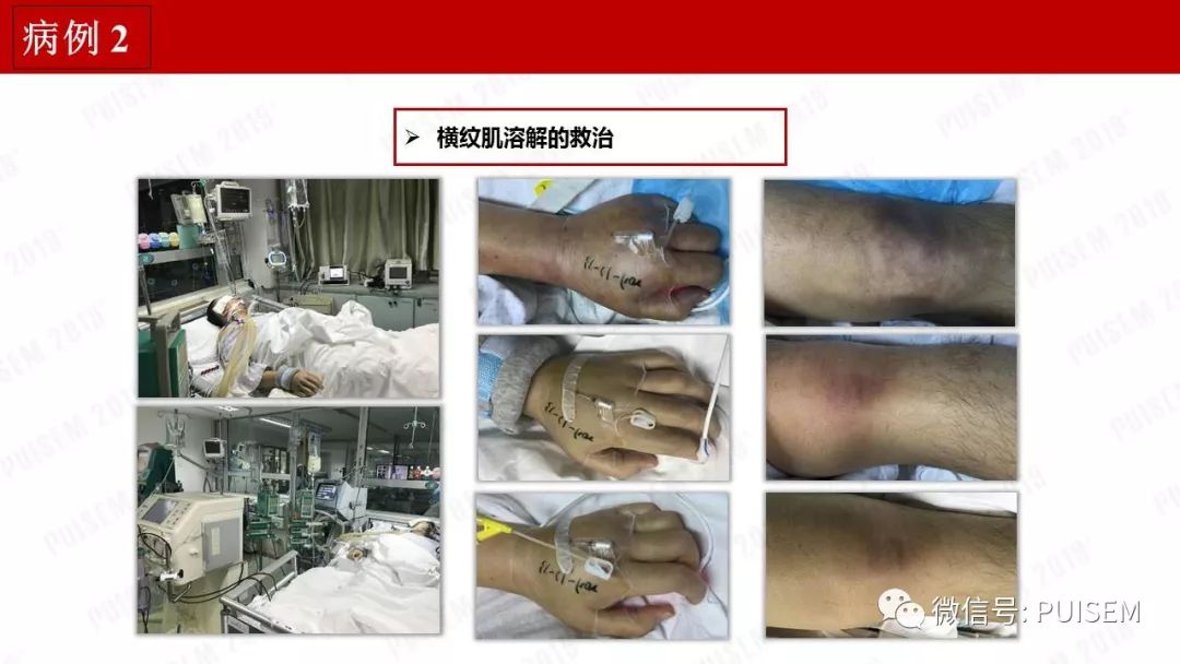 精彩幻灯｜朱海燕：血液净化的抗凝治疗