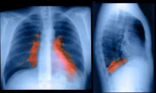 老年人股骨颈骨折康复教程,70岁股骨颈骨折保守治疗成功案例