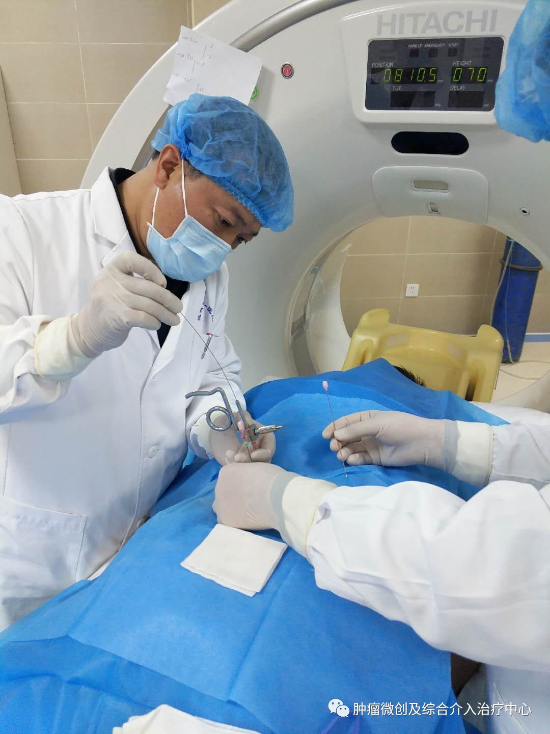 哪些肿瘤患者适合微创介入治疗,晚期癌症能做碘125粒子植入术