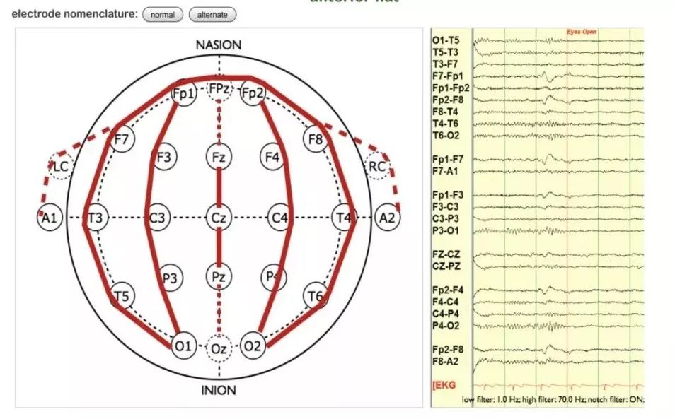 正常脑电图报告单图片,正常脑电图检查报告单第一页