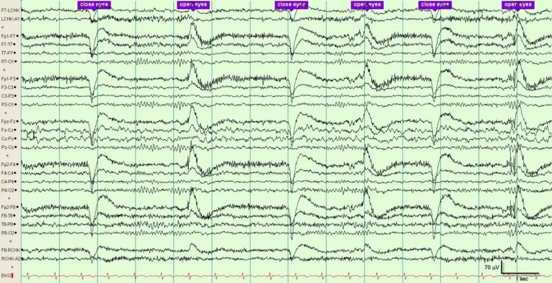 正常脑电图报告单图片,正常脑电图检查报告单第一页
