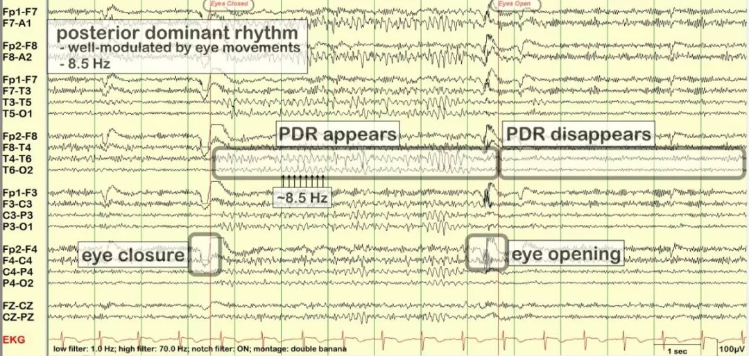 正常脑电图报告单图片,正常脑电图检查报告单第一页
