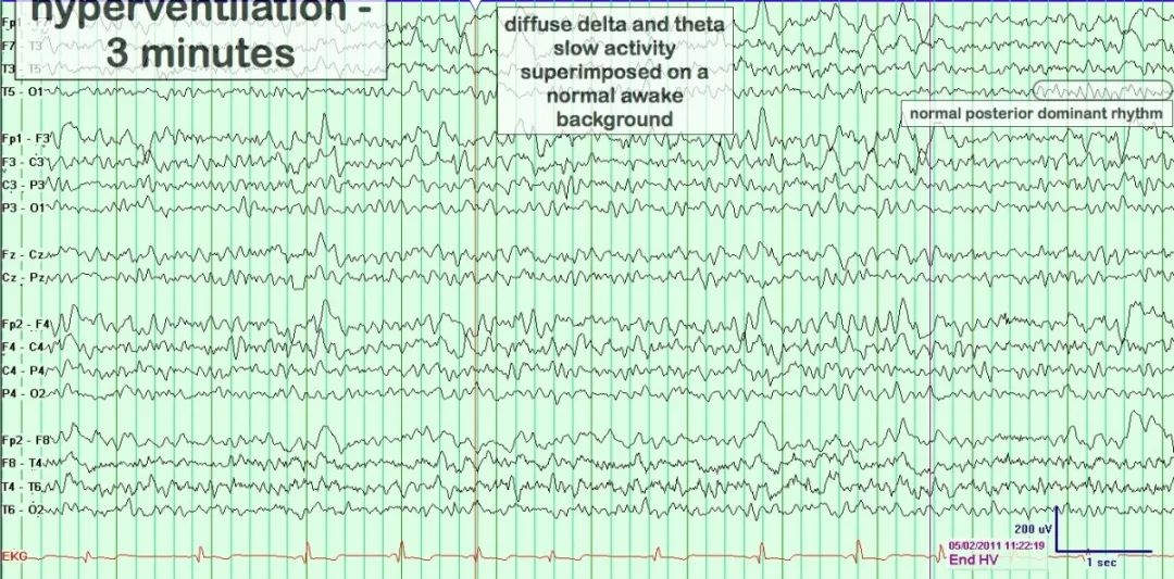 正常脑电图报告单图片,正常脑电图检查报告单第一页