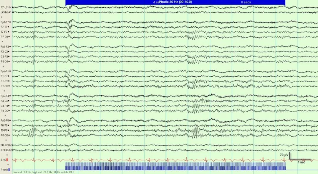 正常脑电图报告单图片,正常脑电图检查报告单第一页