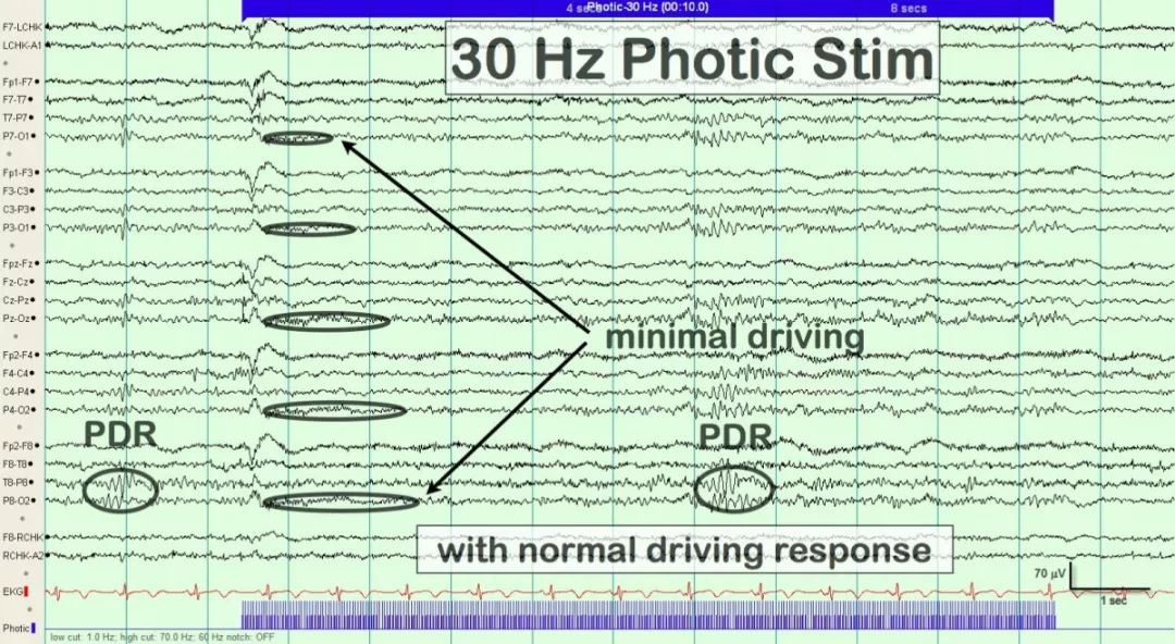 正常脑电图报告单图片,正常脑电图检查报告单第一页