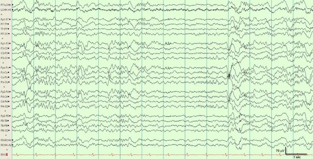 正常脑电图报告单图片,正常脑电图检查报告单第一页