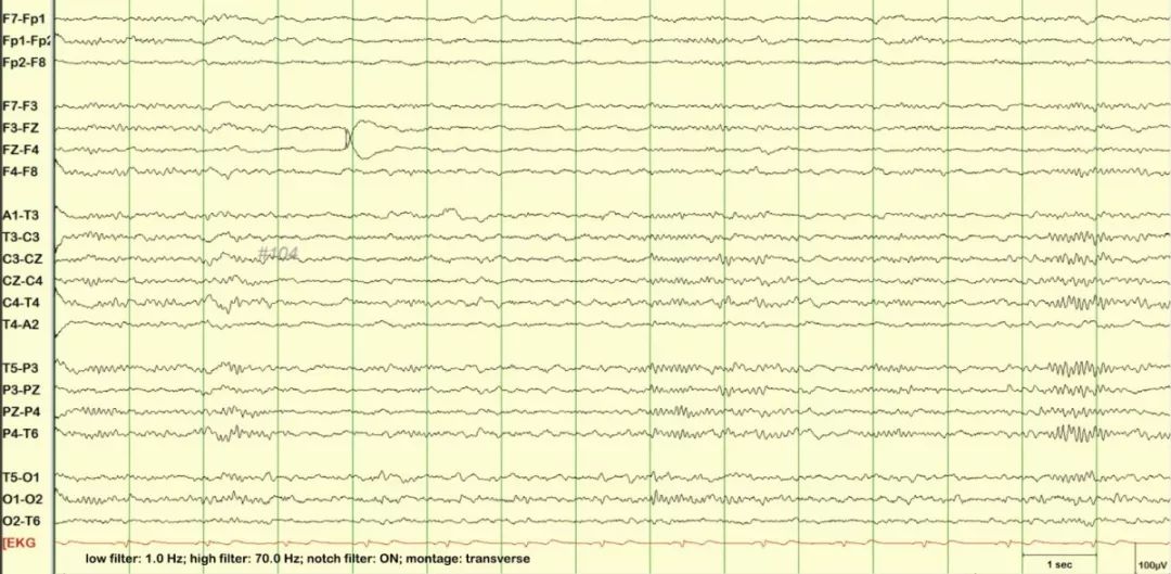 正常脑电图报告单图片,正常脑电图检查报告单第一页