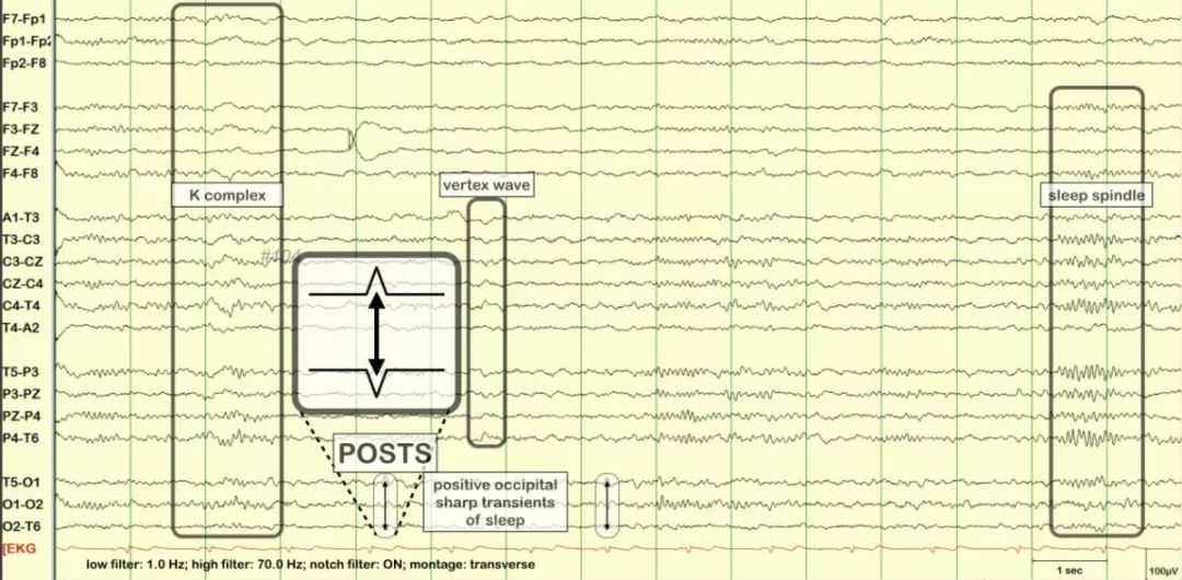 正常脑电图报告单图片,正常脑电图检查报告单第一页